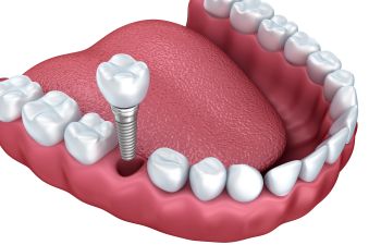 single dental implant