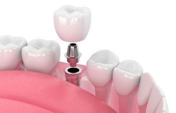 Tooth implant