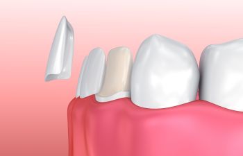 Dental Veneer Application