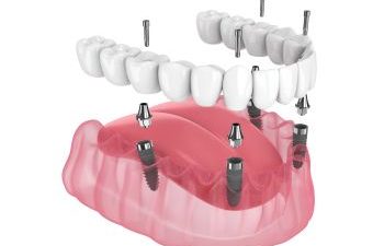 All-on-4 Dental Implants