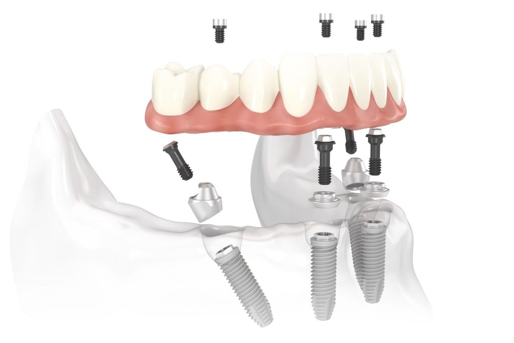 implant-supported denture