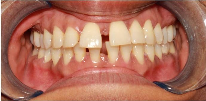 Invisalign Treatment Before & After