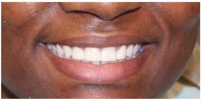 after replace anterior crowns procedure