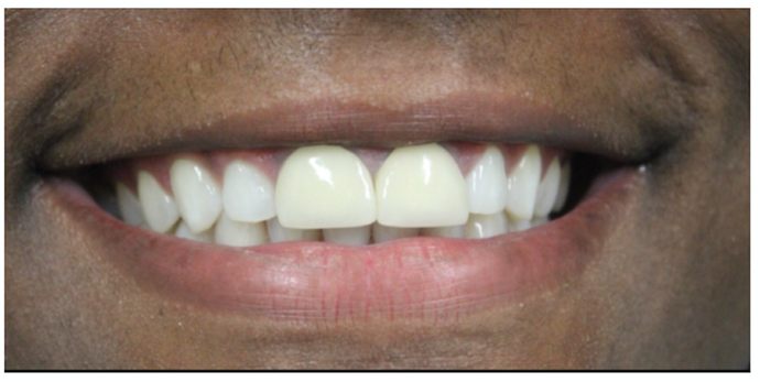 before replace anterior crowns