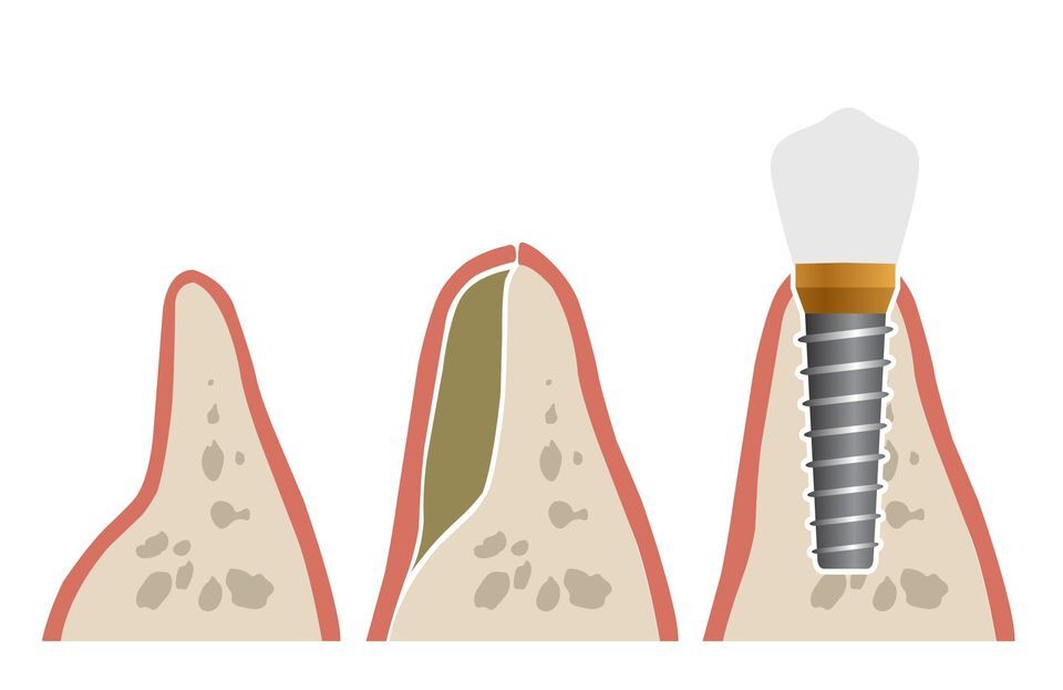 illustration of bone graft stages with a dental implant