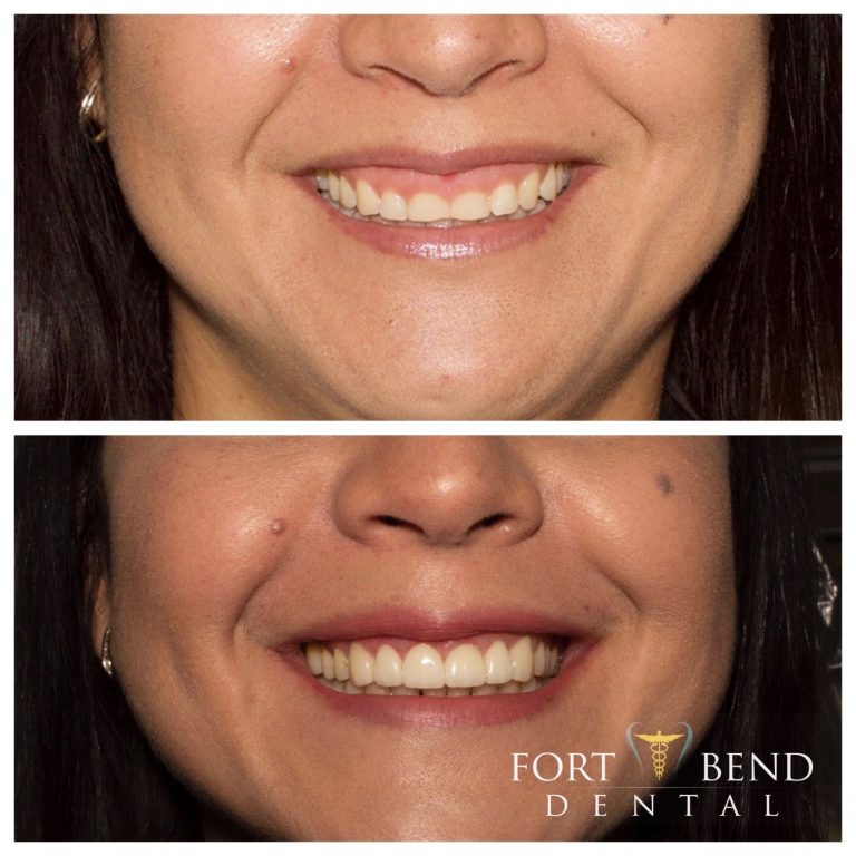 Gum Contouring Missouri City, Richmond, Rosenberg TX Sugar Land, TX