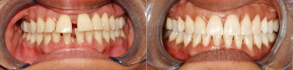 invisalign treatment before after