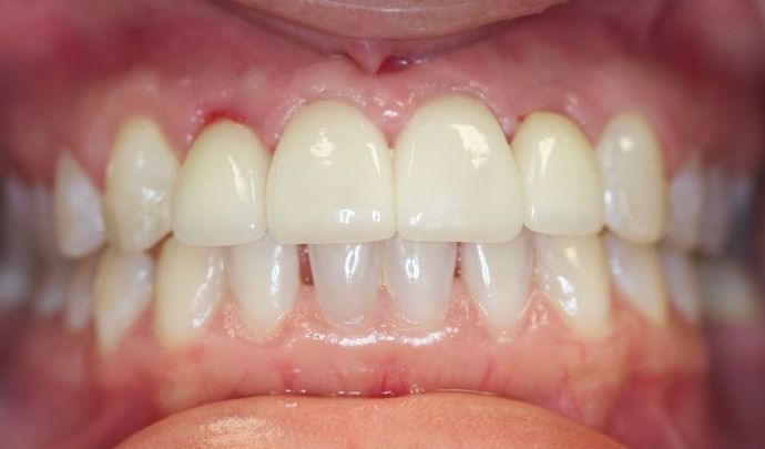 after anterior implant crowns and esthetic crowns