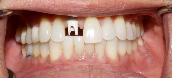 dental implants before the procedure
