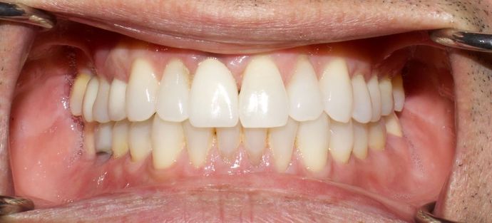 dental implants after the procedure