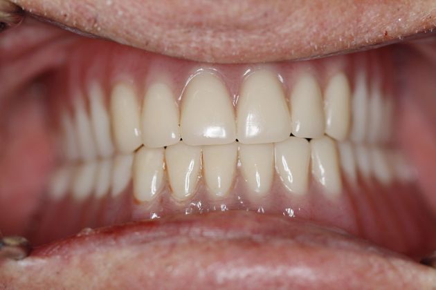 after dentures denture replacement