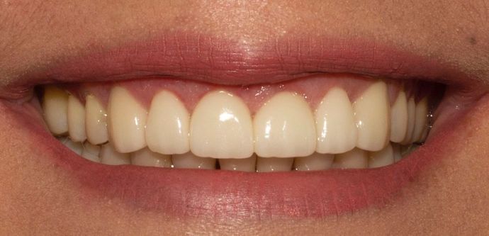 after veneers with gingivectomy
