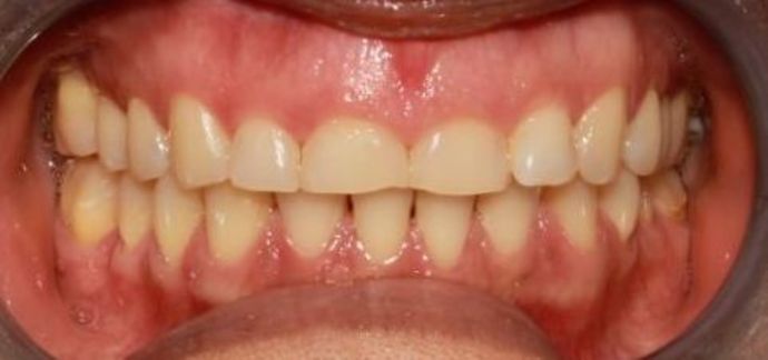 before veneers with gingivectomy