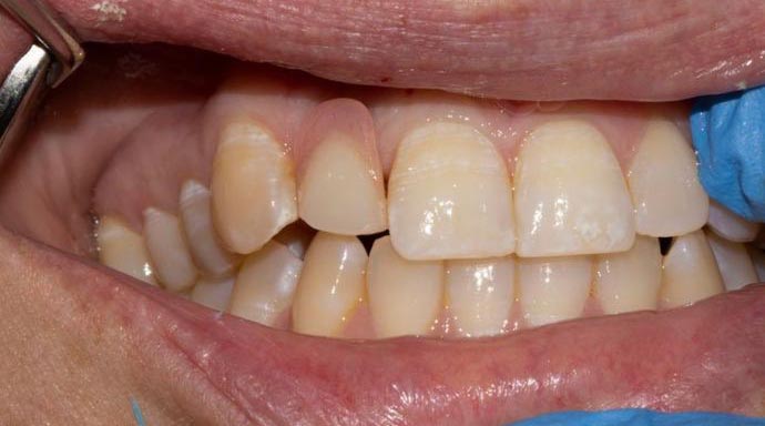 Partial Denture vs Implant Crown
