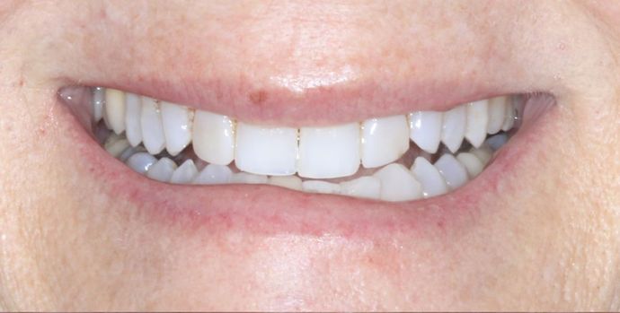 before veneers on lateral incisors