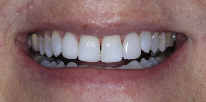 after veneers on lateral incisors