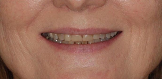 before cosmetic smile makeover procedure