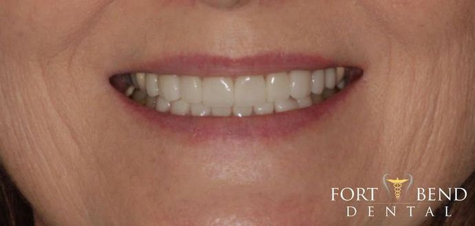 after cosmetic smile makeover procedure