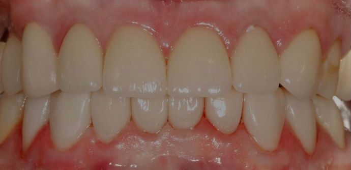 after smile makeover with veneers and crowns