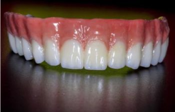 Implant Fixed Denture
