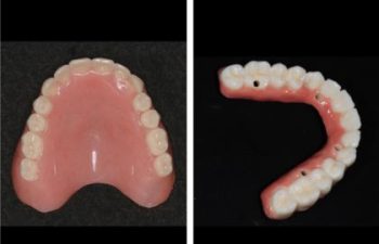 Implant Fixed Denture