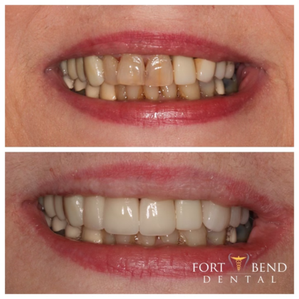 Implant & Crown Front Lateral Tooth #10