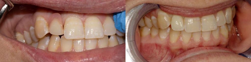 Partial denture vs implant crown