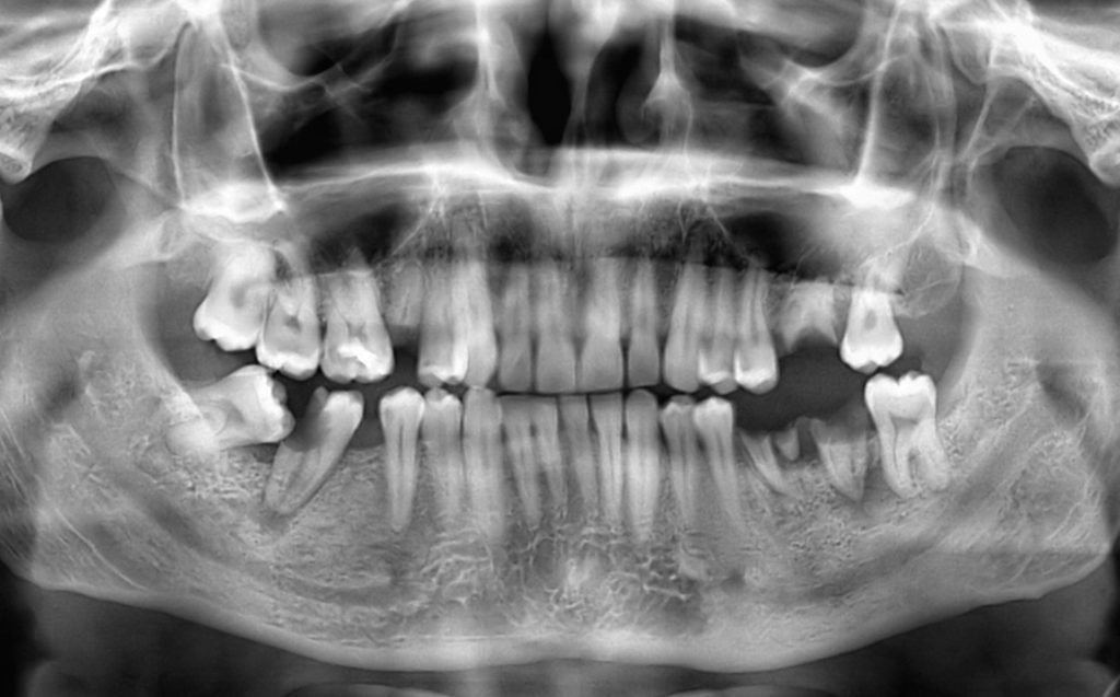 dental x-ray view of teeth