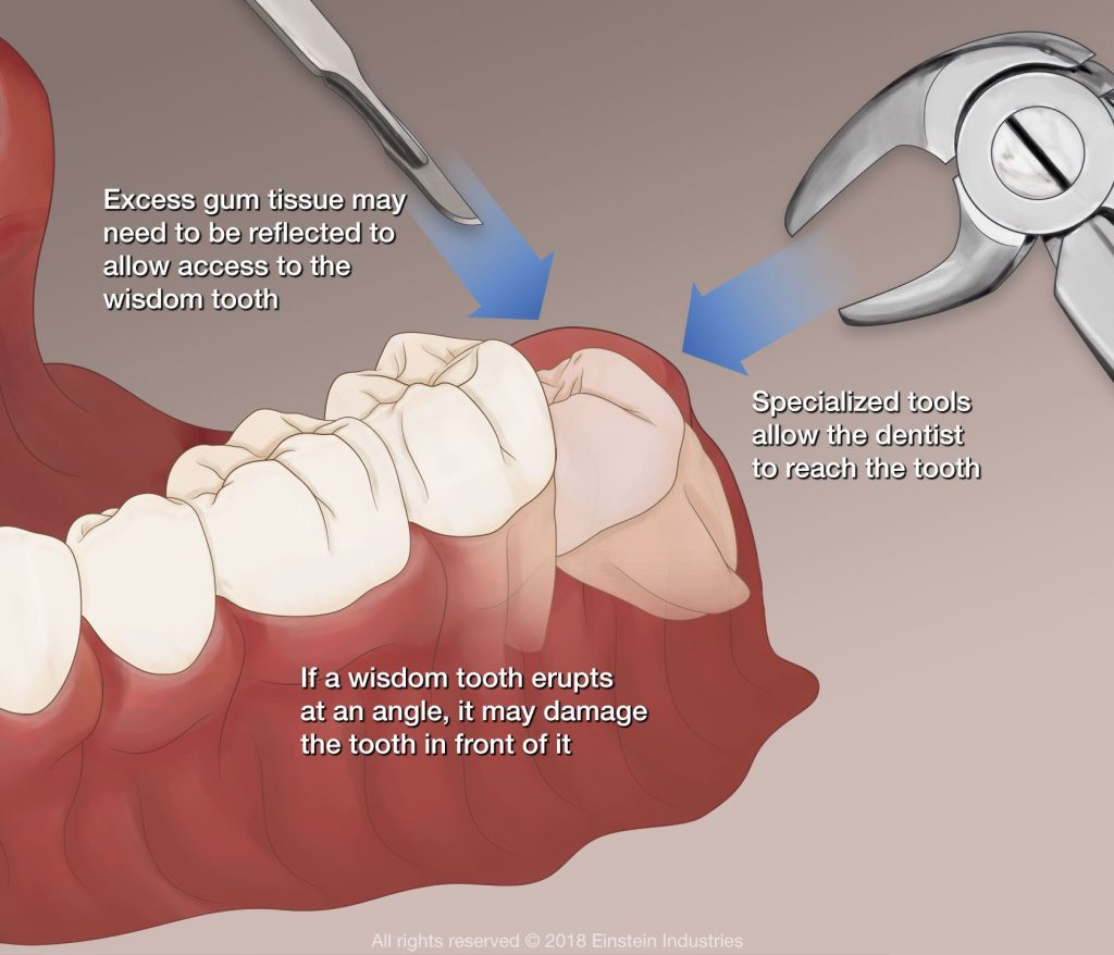 Illustration of wisdom teeth removal