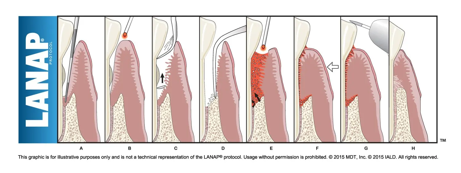 LANAP steps