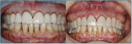 anterior crown replacement