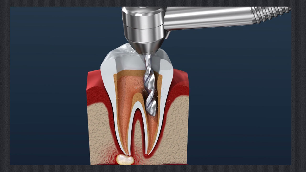 4 канальный пульпит зуба. Прочистка зубных каналов. 4 канальный пульпит зуба. Чистка каналов что это. Чистка каналов что это.