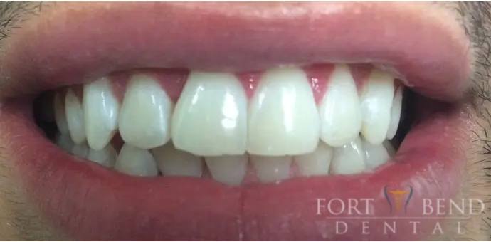 Anterior Crowding 2 after