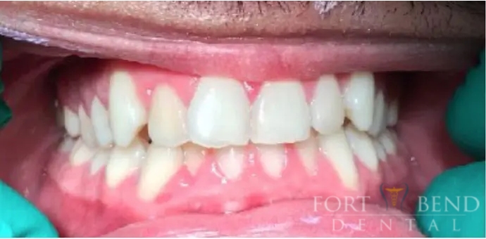 Anterior Crowding 2 before