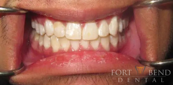 Anterior Crowding after