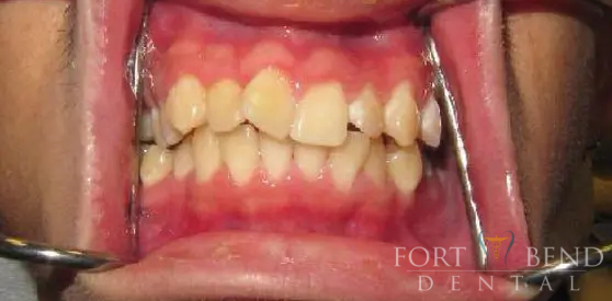Anterior Crowding before