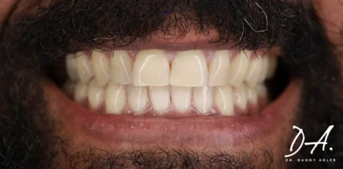 after smile makeover