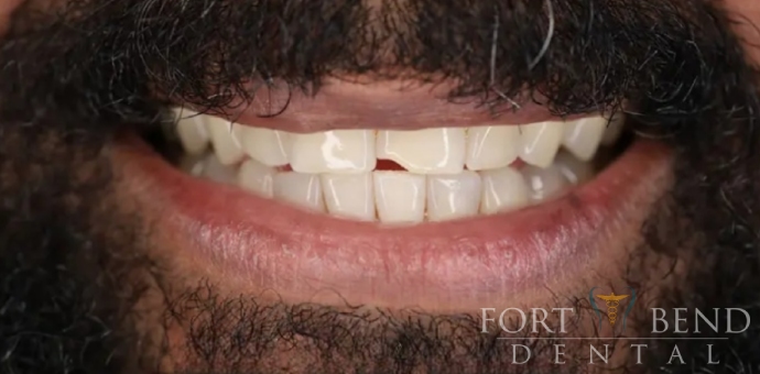 before smile makeover