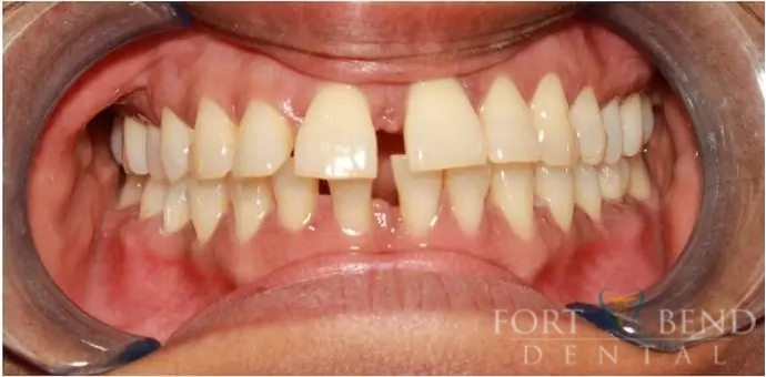 Invisalign photo Before Treatment