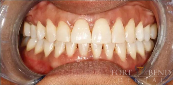 Invisalign photo After Treatment