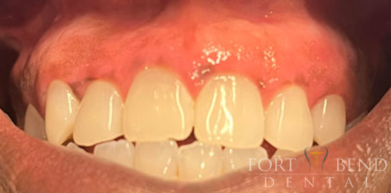 After Laser Depigmentation