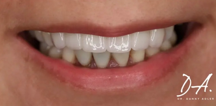 after Anterior Bridge
