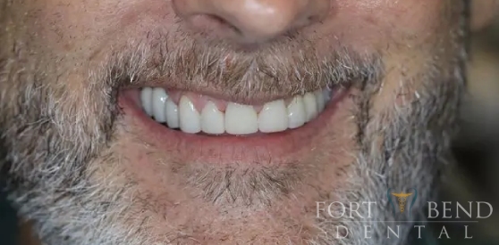 teeth after dental bridge