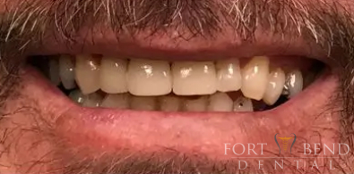 after Cerec - Crowns in a Day!!