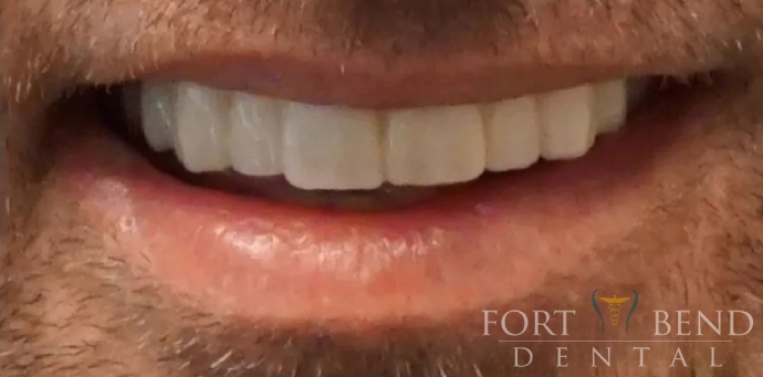 after dental crowns