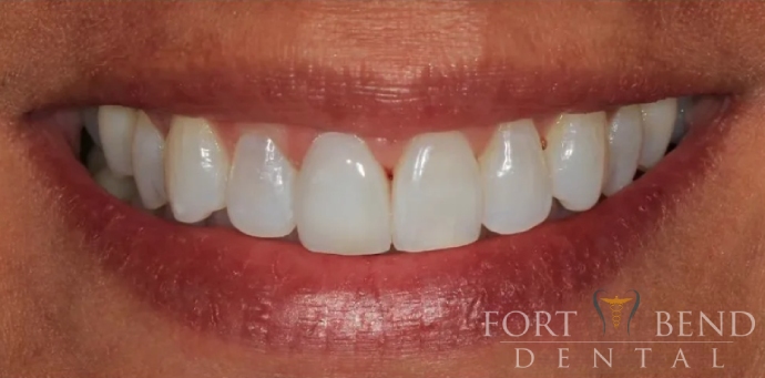 after dental crowns