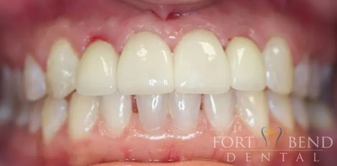 after anterior implant crowns and esthetic crowns