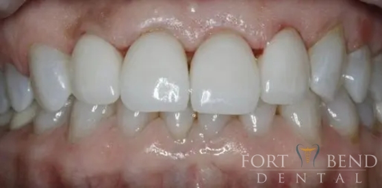 after Porcelain Crown Restoration