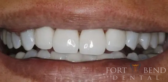 after Porcelain Crown Restoration