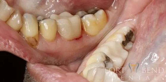 Failing Silver Filling Restored With a Cerec Crown